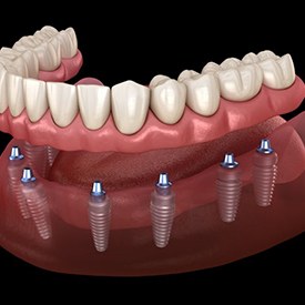 Illustration of implant dentures against dark background
