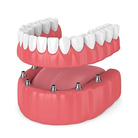 Illustration of fixed implant denture for lower arch