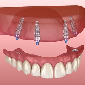 implants and dentures