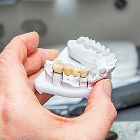 Dental bridge in Mesquite on clay model