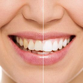 Smile before and after teeth whitening