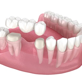 Diagram of a dental bridge in Mesquite