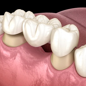 Diagram of a dental bridge in Mesquite