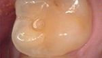 Prpared tooth after decay is removed