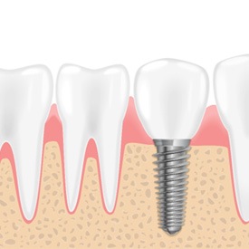 Digital illustration of a dental implant in place