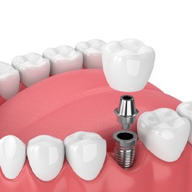 Digital illustration of a single tooth dental implant being placed in mouth 