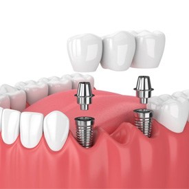 Digital illustration of an implant bridge being placed in a mouth 