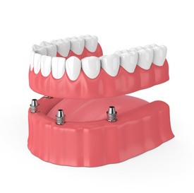 Digital illustration of an implant denture being placed in a mouth