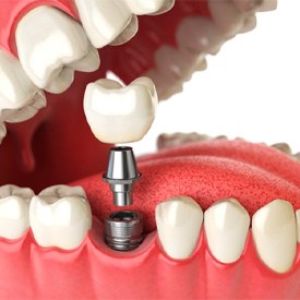 Digital illustration of an open mouth and how a dental implant would be placed 