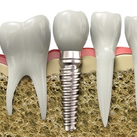 Digital illustration showing a dental implant imbedded into the jawbone next to natural tooth roots 