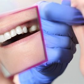 Mirror showing closeup of a patients smile with missing tooth