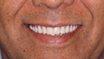 Closeup of smile with implant supported denture