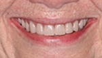 Closeup of smile with implant supported denture