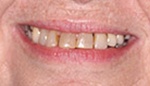 Closeup of dark and discolored denture