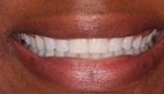 Closeup of perfectly aligned teeth after Invisalign