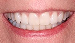 Closeup of perfectly aligned teeth after Invisalign