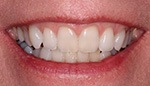 Closeup of woman's unevenly spaced teeth