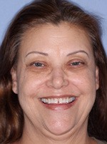 Woman with misaligned smile