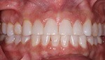 Closeup of gorgeous smile after Invisalign