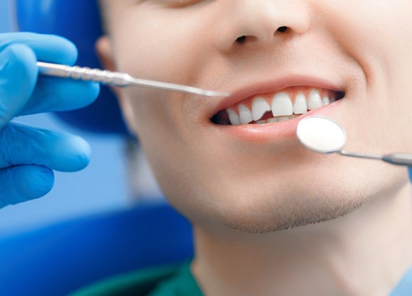 Repair cavities and broken teeth near Sunnyvale