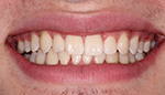 Closeup of gorgeous smile after Invisalign