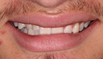 Closeup of misaligned bite