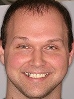 Man with yellowed damaged teeth