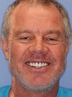 Older man with damaged uneven smile
