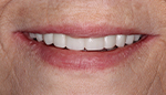 Closeup of smile with implant supported denture