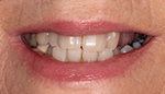 Closeup of dark and discolored denture