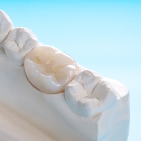 An up-close view of a metal-free dental crown sitting on the lower arch of a mouth mold in Mesquite