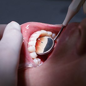 Closeup of healthy teeth and gums