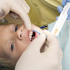 Child receiving fluoride treatment