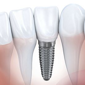 Animation of implant supported dental crown