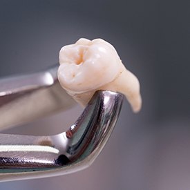 Metal clasp holding extracted tooth