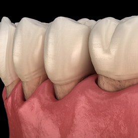 gum recession in gum disease in Mesquite