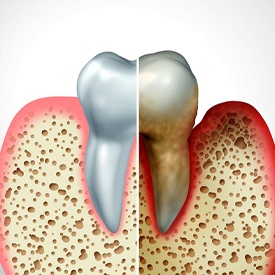 advanced periodontal disease in Mesquite