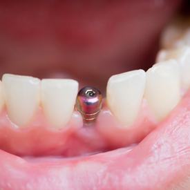 A single implant placed inside of a patient’s jaw.