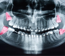 x-ray of wisdom teeth