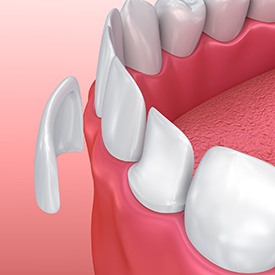 Animation of porcelain veneer placement