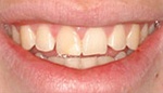 Smile with over large front teeth