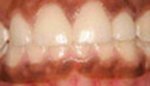 Closeup of flawless top and bottom teeth