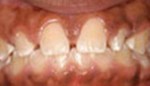Closeup of gap between teeth and over bite