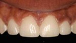 Closeup of top teeth with veneers