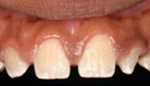 Closeup of gap between front teeth