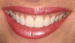 Flawless smile after veneer placement