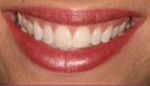 Closeup of teeth with uneven smile line