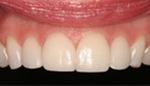 Gorgeous top teeth after veneer placement