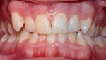 Closeup teeth before whitening