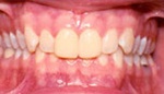 Yellow teeth before whitening